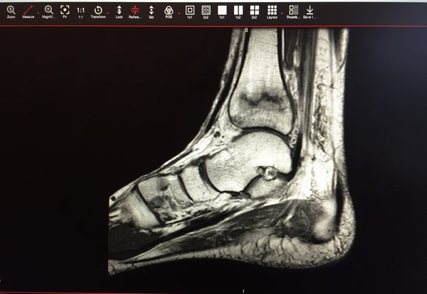 MRI of ankle.
