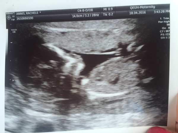 October 2016 (thread number four). Entering the second trimester.