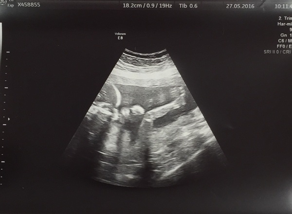 October 2016 (thread number four). Entering the second trimester.