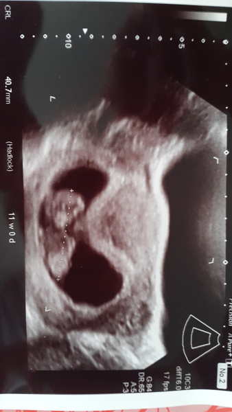 Morning sickness and first scan anticipation - it's the December 2016 babies.