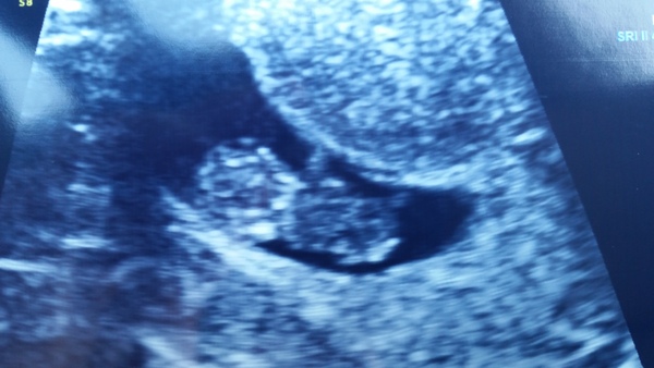 Morning sickness and first scan anticipation - it's the December 2016 babies.