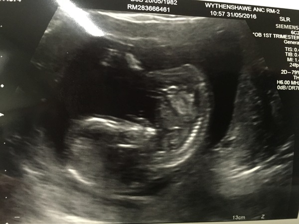 More scan waiting and symptom analysis from the December 2016 babies!