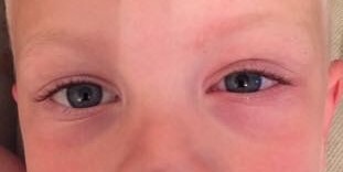 Is there something wrong with son's eye? How would you treat it?