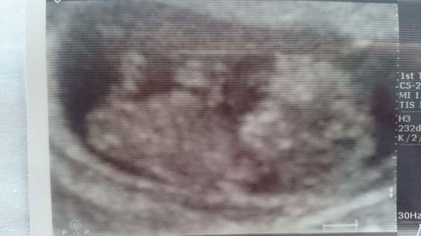 More scan waiting and symptom analysis from the December 2016 babies!