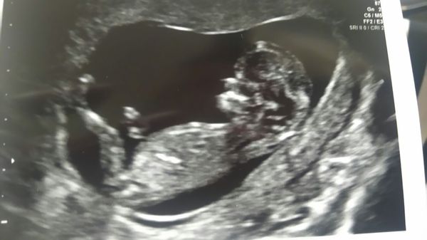 More scan waiting and symptom analysis from the December 2016 babies!