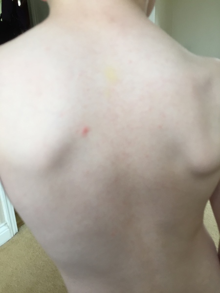 Chicken pox