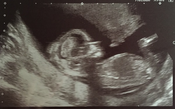 More scan waiting and symptom analysis from the December 2016 babies!