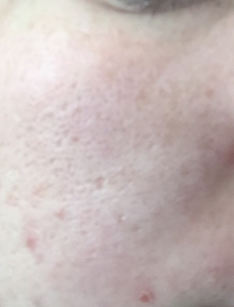 my skin is so awful (pics)