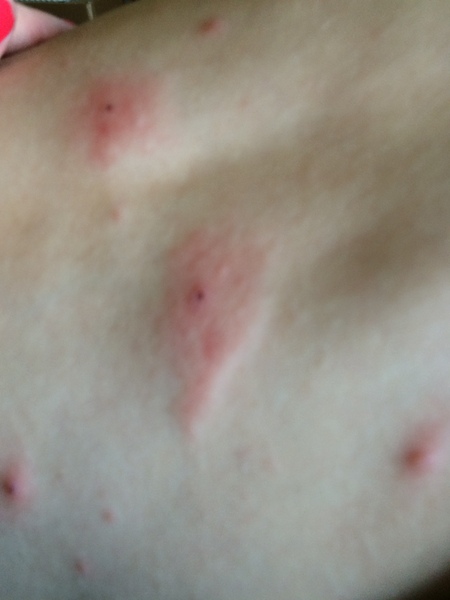 Chicken Pox help