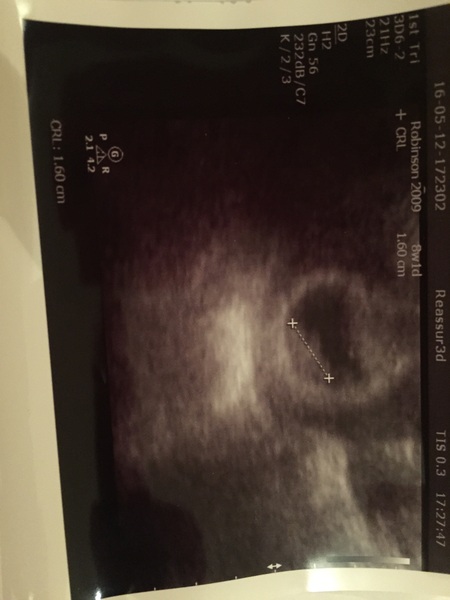 More scan waiting and symptom analysis from the December 2016 babies!