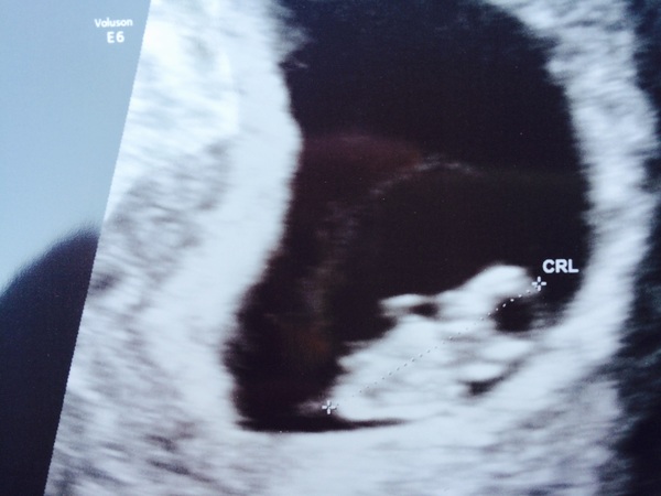 Morning sickness and first scan anticipation - it's the December 2016 babies.