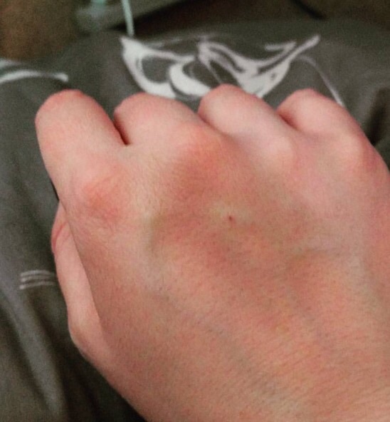 DS (13) had a blood test earlier; he now can't move his hand and it's bruised...