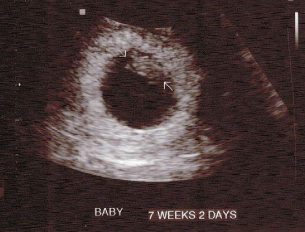 Morning sickness and first scan anticipation - it's the December 2016 babies.