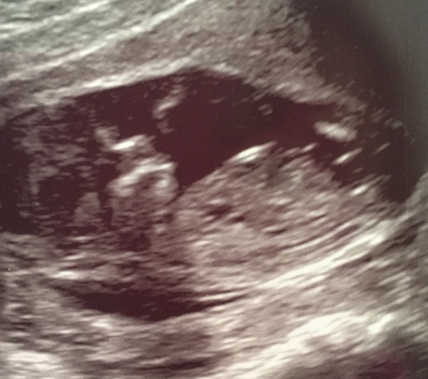 More scan waiting and symptom analysis from the December 2016 babies!