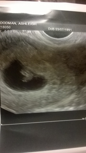 Grab your scans ladies for the...drumroll...Ramzi Placenta Theory!