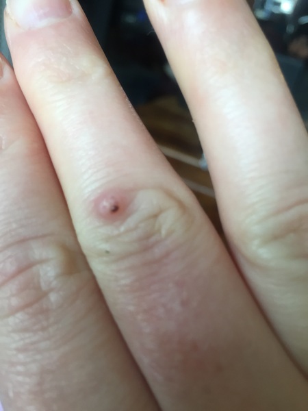What actually works for warts and verrucas?