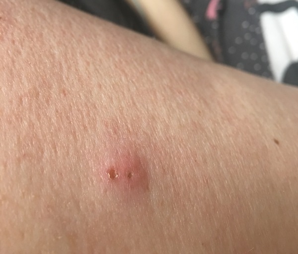 what is this on my arm