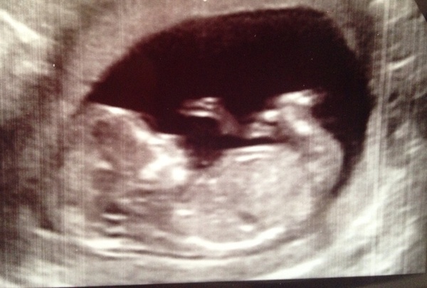 More scan waiting and symptom analysis from the December 2016 babies!