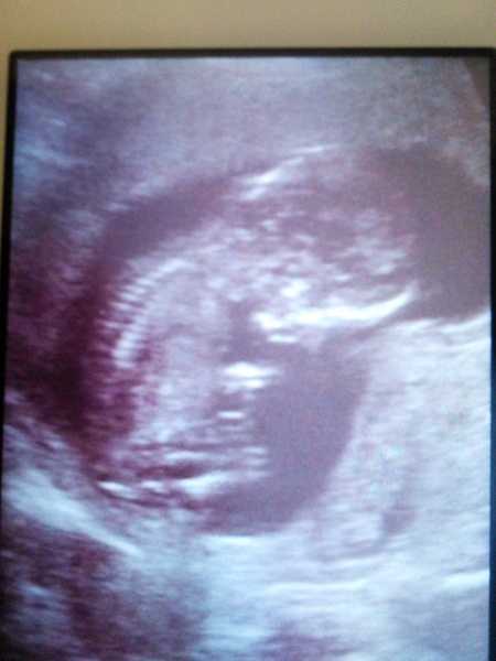 Pregnancy after infertility