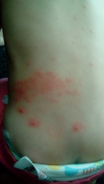Is this normal for chickenpox? Pic attached