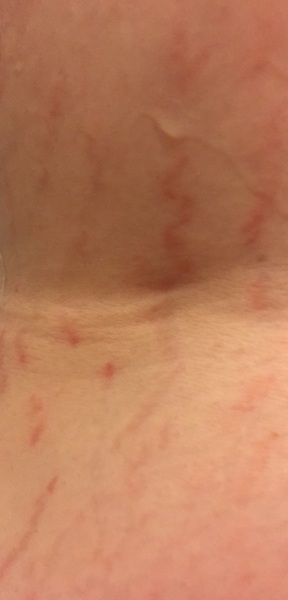 Are DD's stretch marks bad?