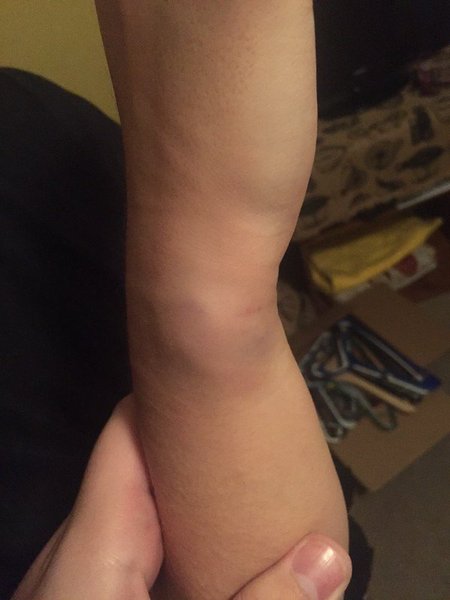 Do you think my son's wrist is broken?