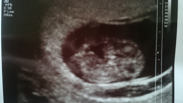 Morning sickness and first scan anticipation - it's the December 2016 babies.