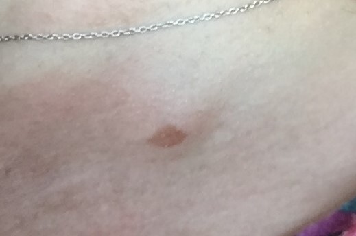Is this a mole or an age spot?