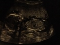 October 2016 (thread number four). Entering the second trimester.