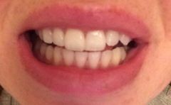 talk to me about your teeth whitening experience