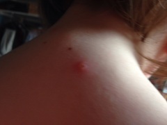 is this chicken pox?