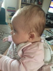 Flat head syndrome