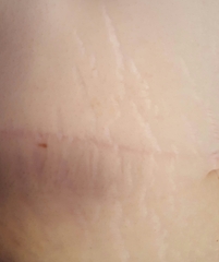 Are DD's stretch marks bad?
