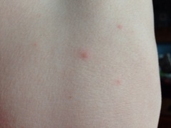 is this chicken pox?