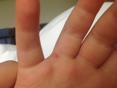 Wart on hand?