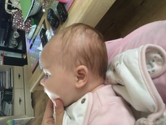 Flat head syndrome