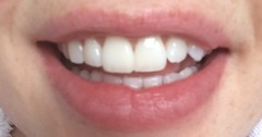 talk to me about your teeth whitening experience
