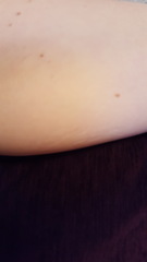 Are DD's stretch marks bad?