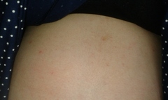 Belly spots?
