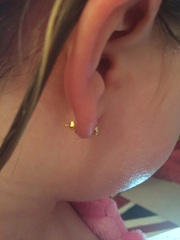 botched ear piercing