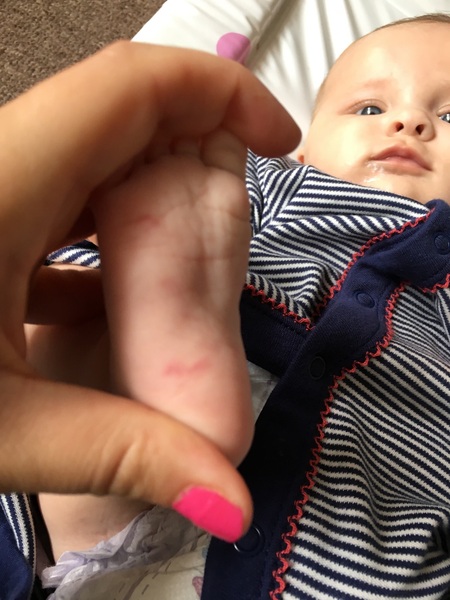Mark/bruise on 3month old foot
