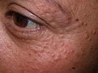Xanthelasma  (cholesterol deposits around eyes)...