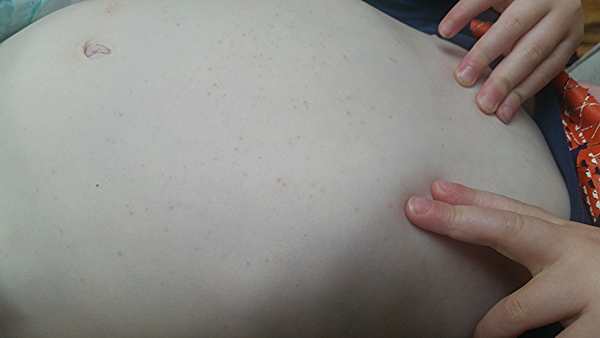 Long term non blanching rash