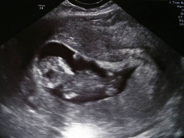 Dating Scan wasn't clear.