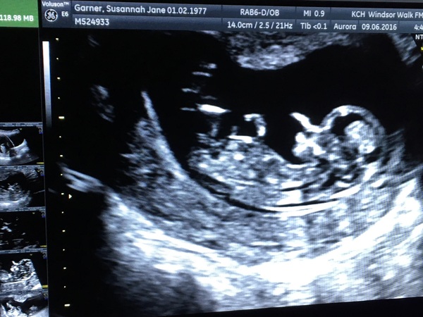 Baby nub boy or girl