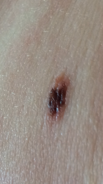 Mole- two week referral