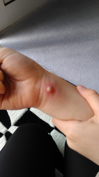 molluscum contagiosum  Help!