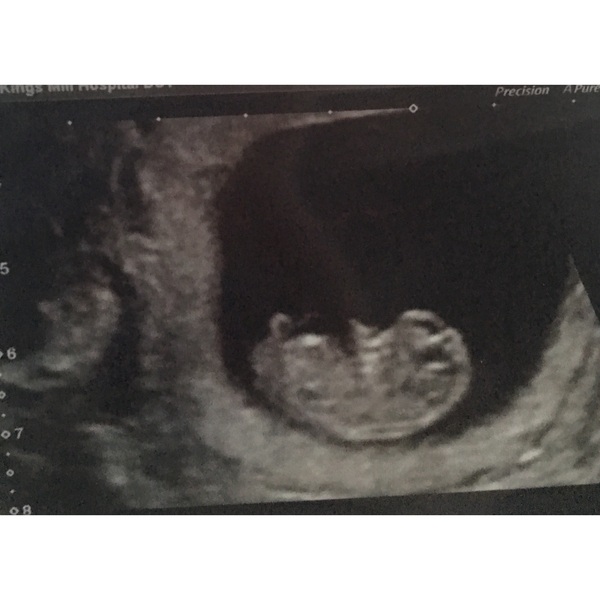 Any thoughts on this scan! (Find out the gender next Wednesday!)