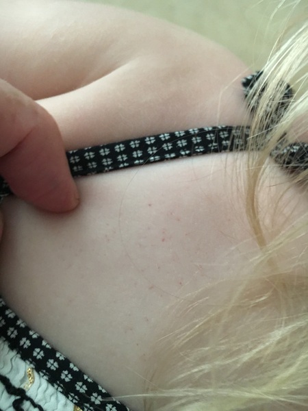 Petechiae rash (photo)