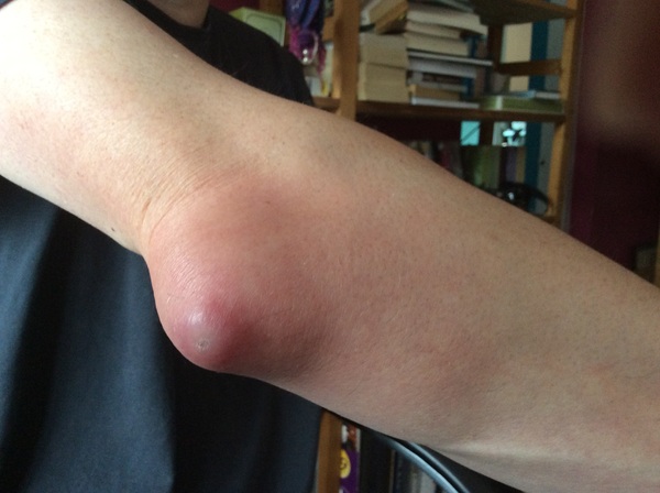 Dh's elbow, in all its glory!